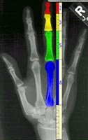 x-ray of hand